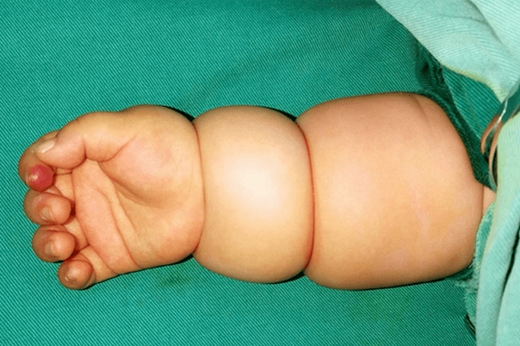 婴儿莲藕臂图 婴儿莲藕臂图