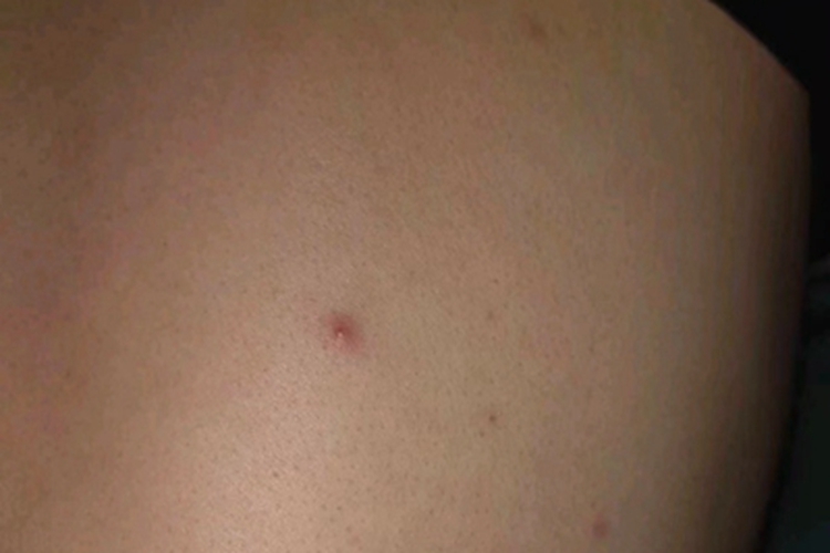 毛囊炎背部有单个丘疹图