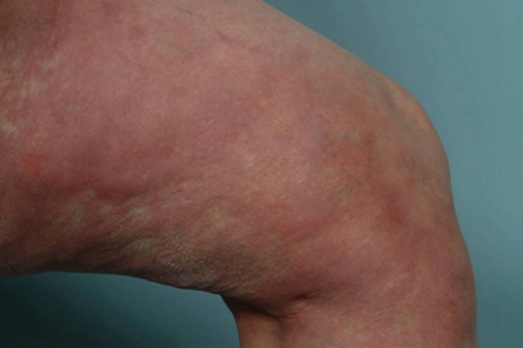 嗜酸性筋膜炎大腿症状图 嗜酸性筋膜炎大腿症状图