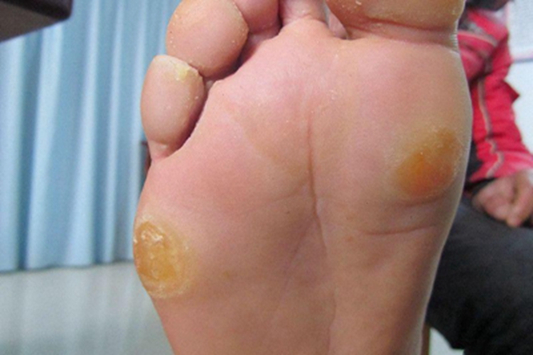 胼胝脚底黄色硬皮图