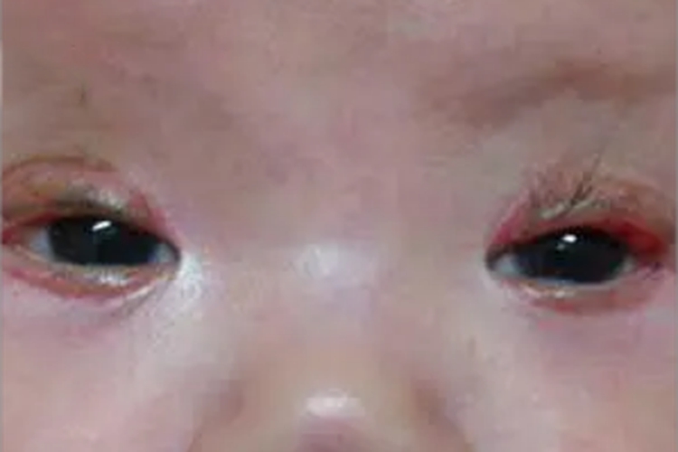 溃疡性睑缘炎红肿图 溃疡性睑缘炎红肿图