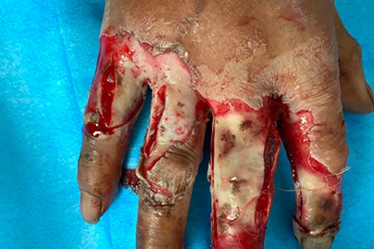 Ⅲ度烧伤手指脱皮图 Ⅲ度烧伤手指脱皮图