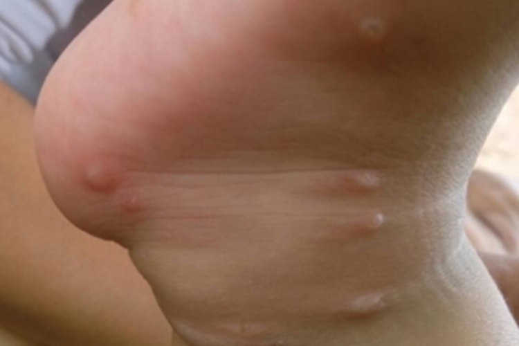 水痘脚踝水疱图