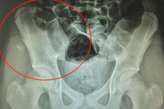 骨盆边缘部撕脱性骨折图