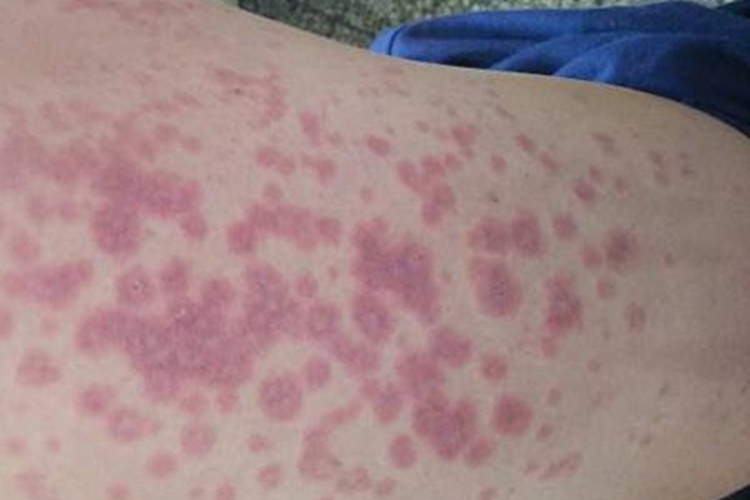 大腿斑疹性梅毒疹图