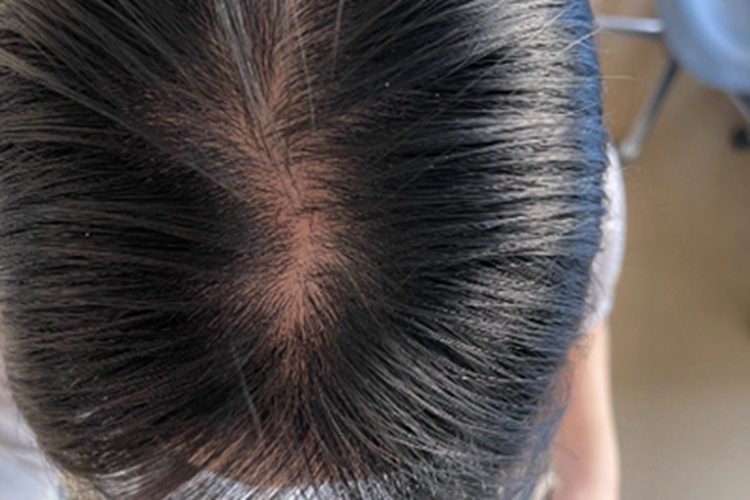 女性型脱发症状图