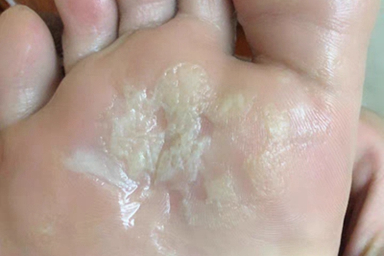 浸渍糜烂型足癣脚底水疱图