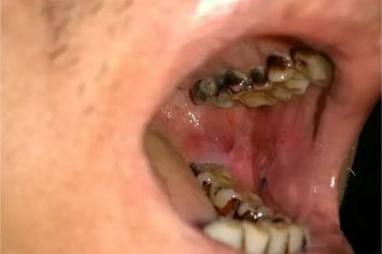 颊癌口腔红斑图 颊癌口腔红斑图