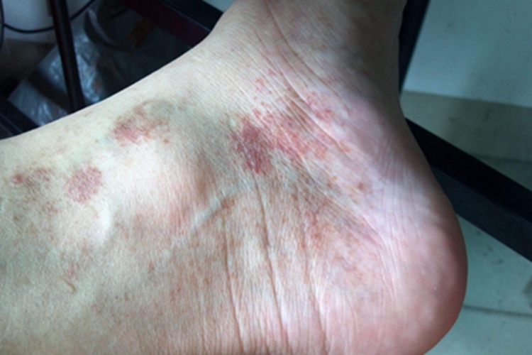 寒冷性多形红斑脚踝长斑图