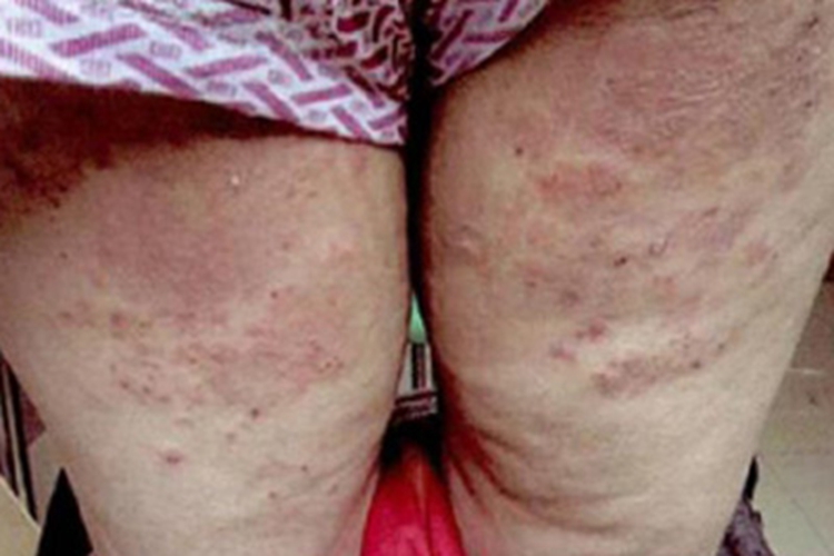 疱疹样皮炎大腿丘疹图 疱疹样皮炎大腿丘疹图