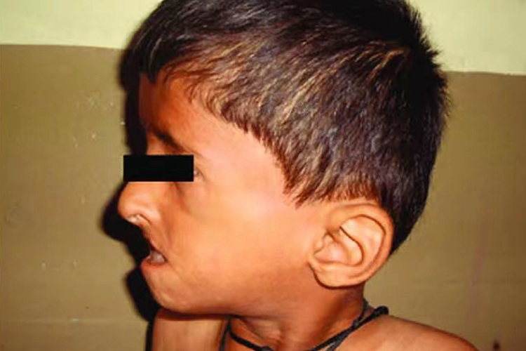 低位耳图 低位耳图