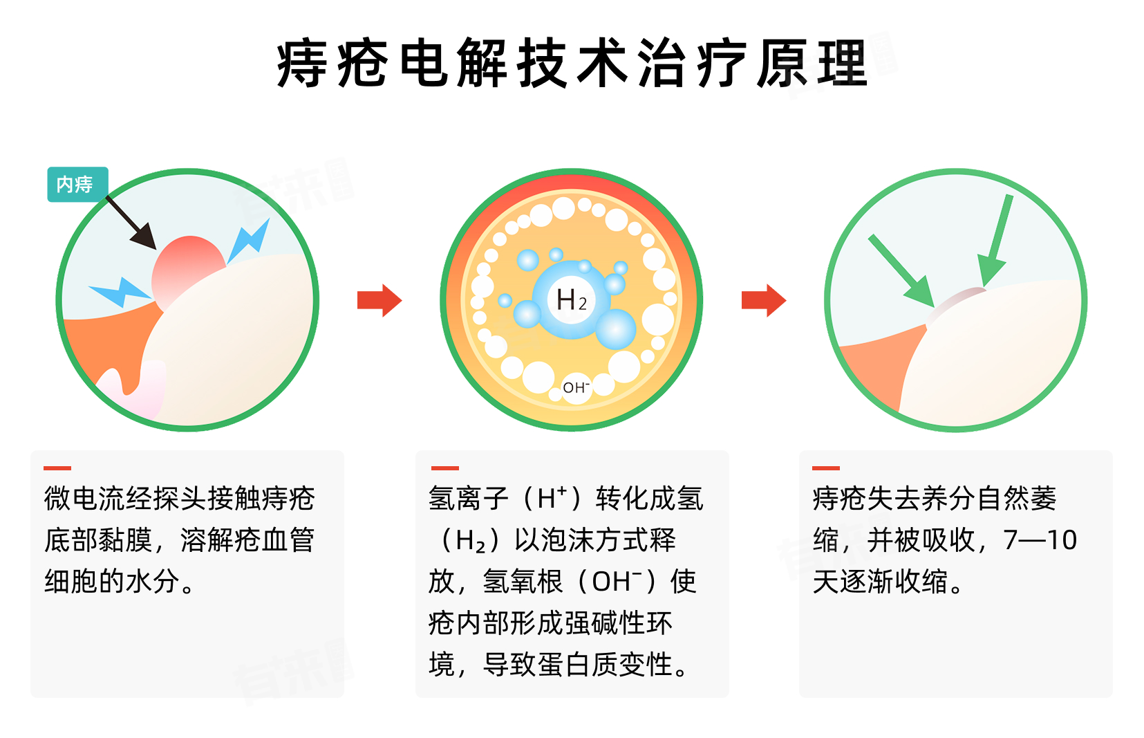 什么是术中探头电解痔疮的原理是什么?揭秘它的神奇之处!-上海聚慕医疗器械有限公司
