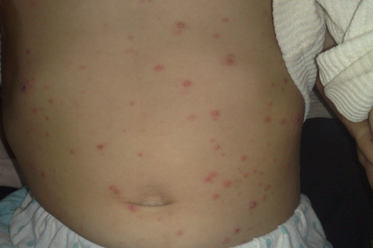 肚子水痘图 肚子水痘图