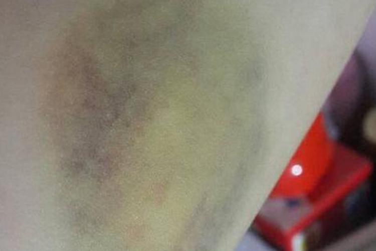 褐色和绿色淤青图