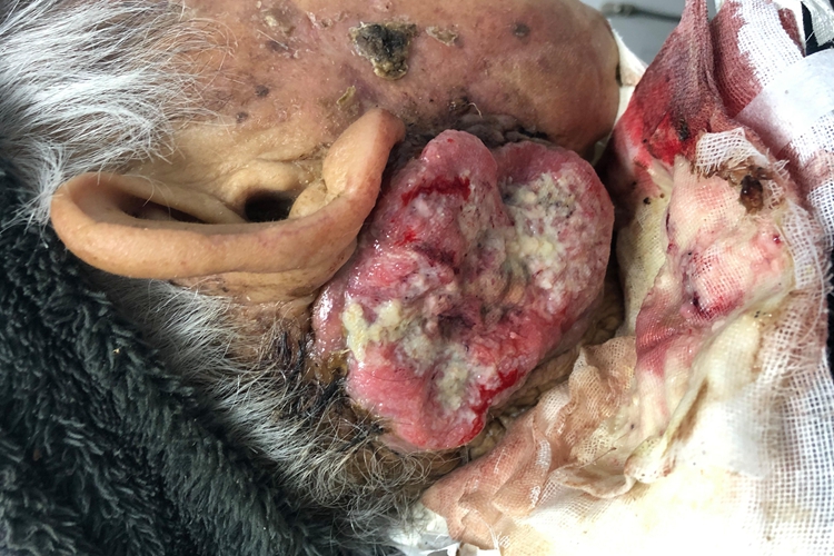 颈部鳞状细胞癌图 颈部鳞状细胞癌图