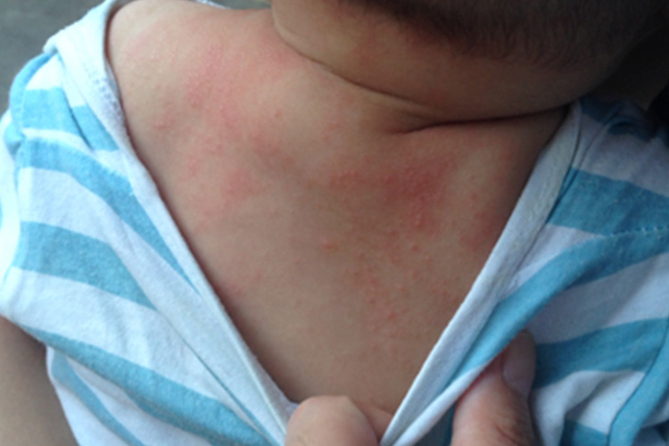 宝宝皮肤斑丘疹图