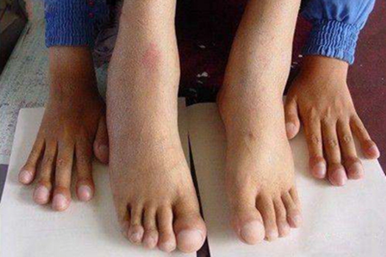 杵状指脚趾皮肤粗糙图