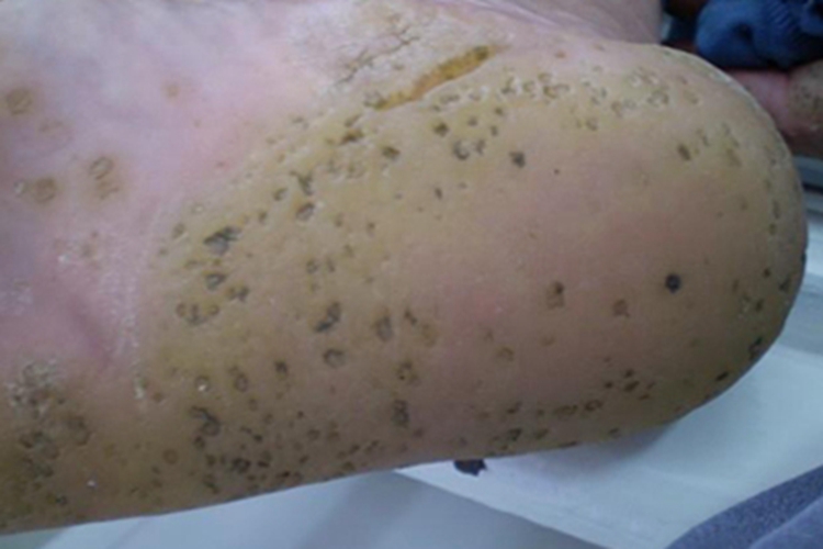 掌跖点状角化足跟症状图