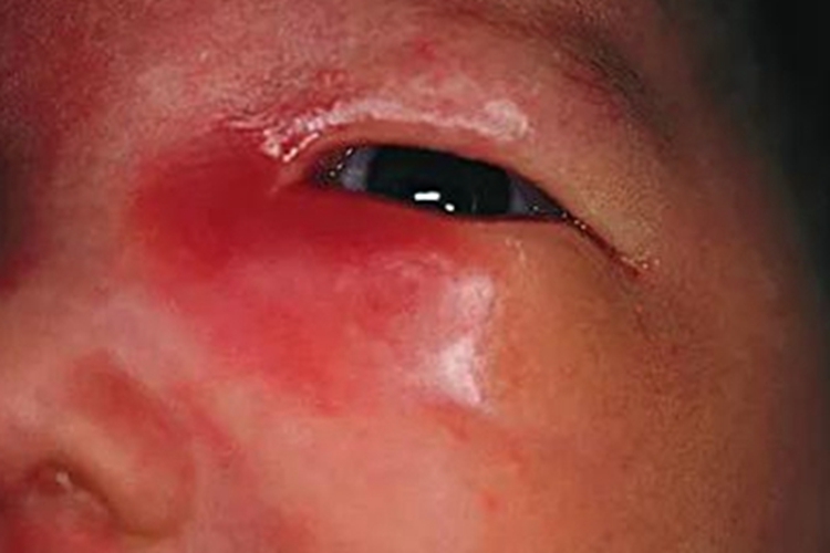 眼睑淋病下眼睑红肿图