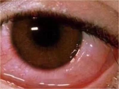 儿童过敏性结膜炎眼睛内弥漫性红肿图.jpeg