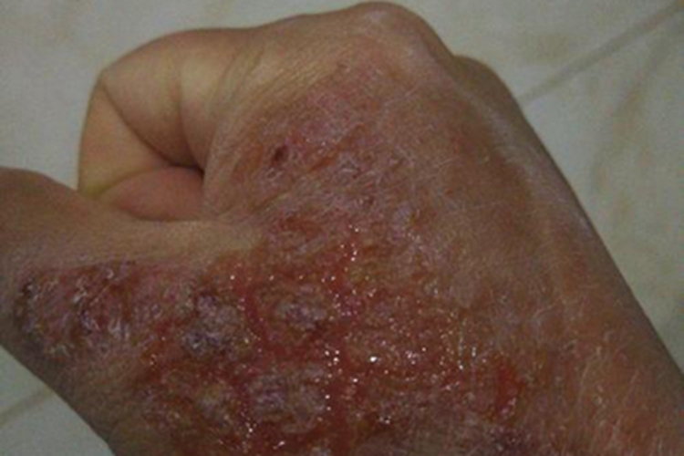 溃疡性皮肤结核渗液图 溃疡性皮肤结核渗液图