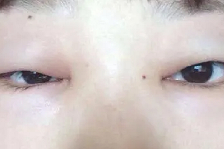 肾性水肿眼睑水肿图