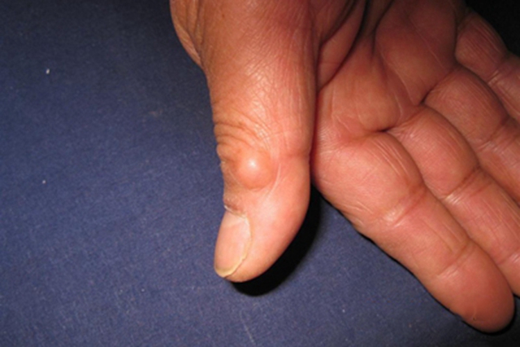 黏液样囊肿手指包块图 黏液样囊肿手指包块图