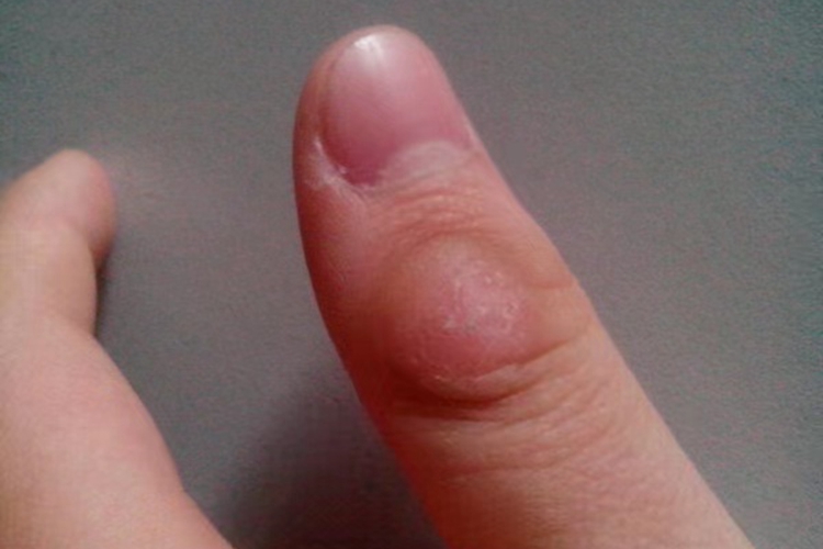 手指骨质增生图 手指骨质增生图