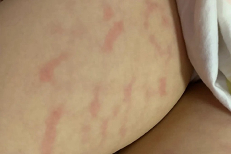 火激红斑大腿上有红斑图