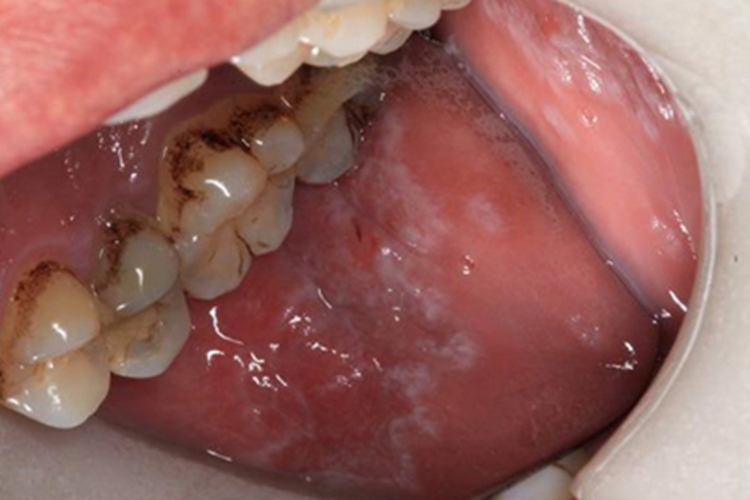 先天性角化不良口腔白斑图
