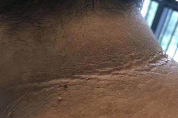 黑棘皮病颈部小疙瘩图