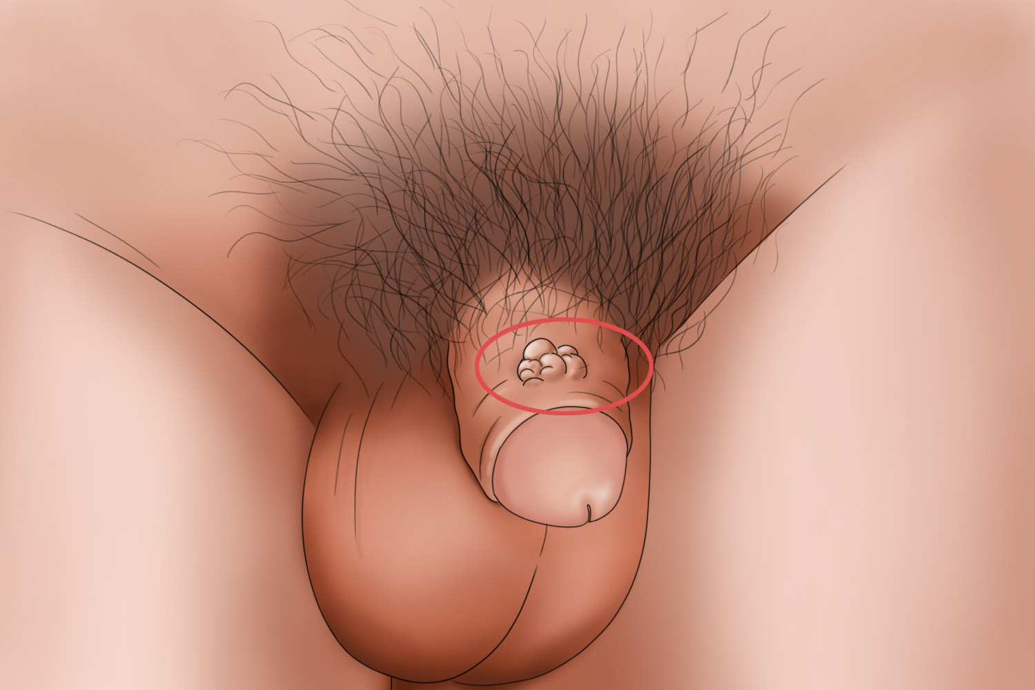 包皮瘢痕疙瘩图