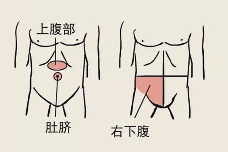 阑尾炎转移性右下腹痛图