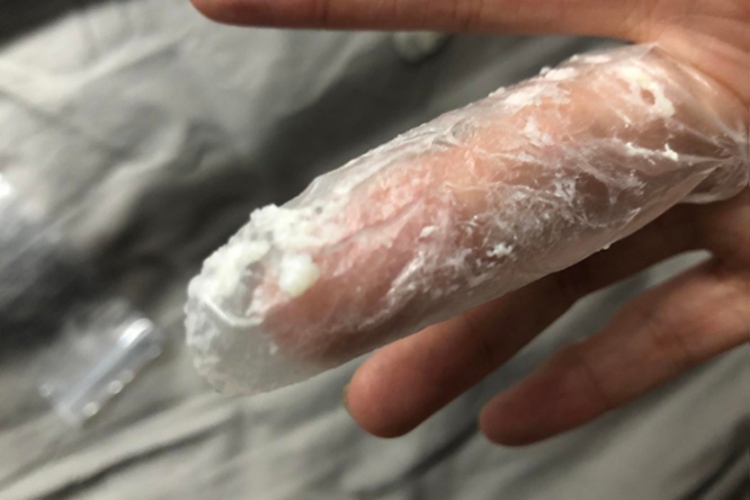 念珠菌性阴道炎分泌物图 念珠菌性阴道炎分泌物图