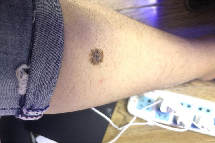 恶性雀斑痣样黑素瘤小腿长褐斑图