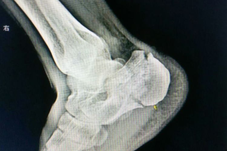 跟骨粉碎性骨折影像图