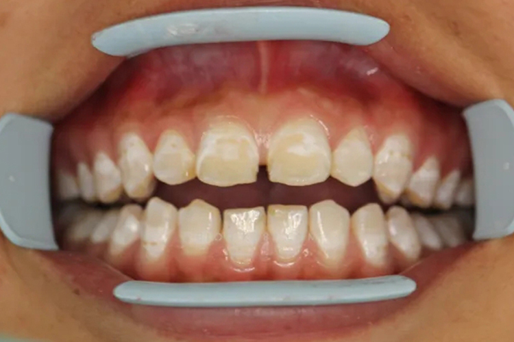 四环素牙图 四环素牙图