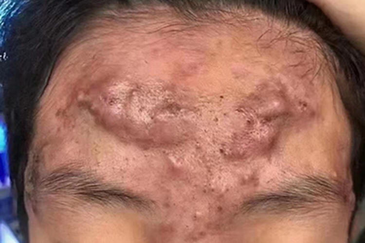 增生性瘢痕疙瘩图