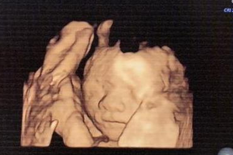 二十一周胎儿影像图