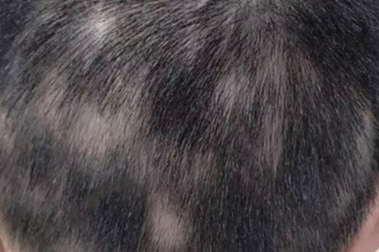 二期梅毒头皮症状图