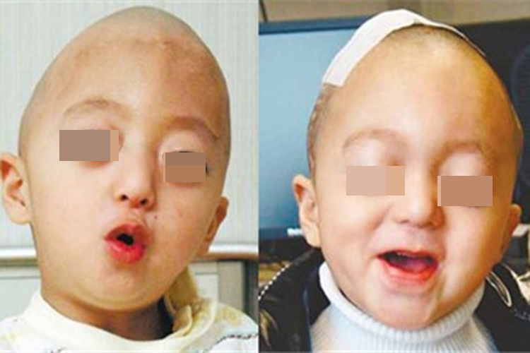 宝宝尖头畸形图