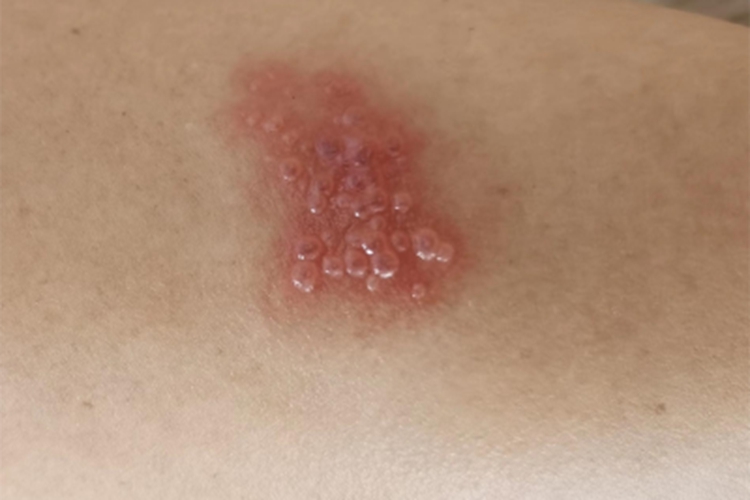 带状疱疹水疱图