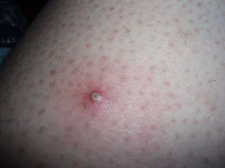 屁股上毛囊炎图