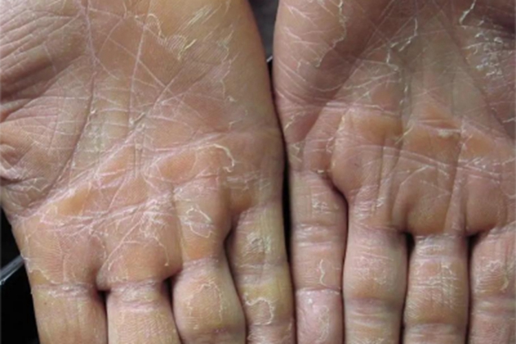 弥漫性掌跖角化病脱皮图