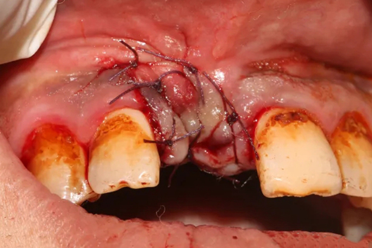 牙根囊肿手术后缝合图 牙根囊肿手术后缝合图