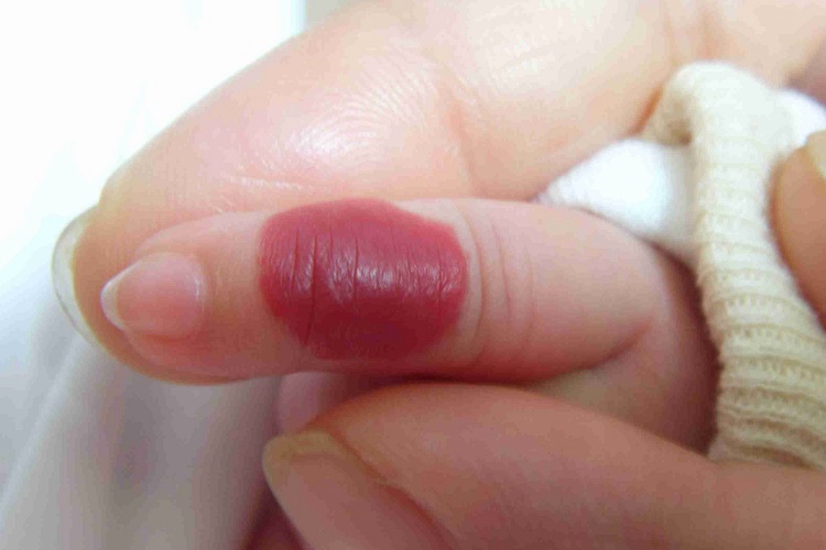 血管瘤手指症状图