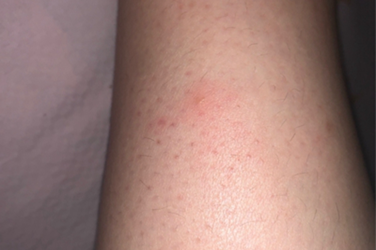 毛囊角化病结节图