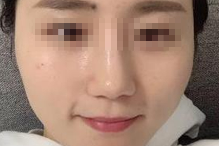 隆鼻后恢复自然图