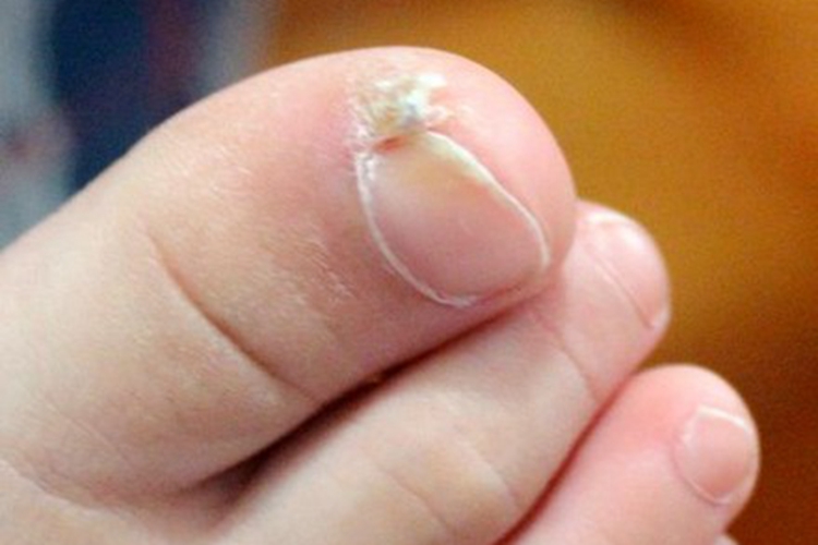 小孩子大脚趾边缘胼胝图 小孩子大脚趾边缘胼胝图