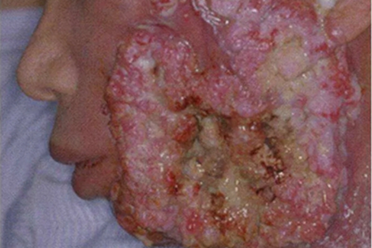 颊癌左脸溃疡糜烂图